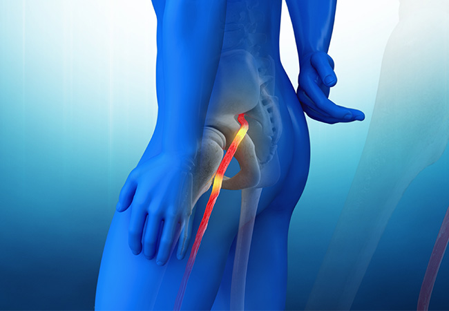 Is It Back Pain Or Sciatica?